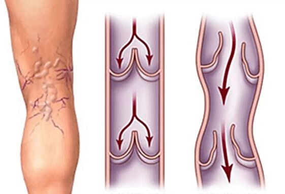 Normal vein and varicose vein