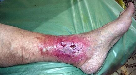 Complications for varicose veins
