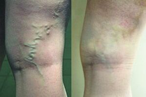 Varices on the legs