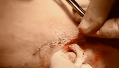 types of operations to eliminate varicose veins