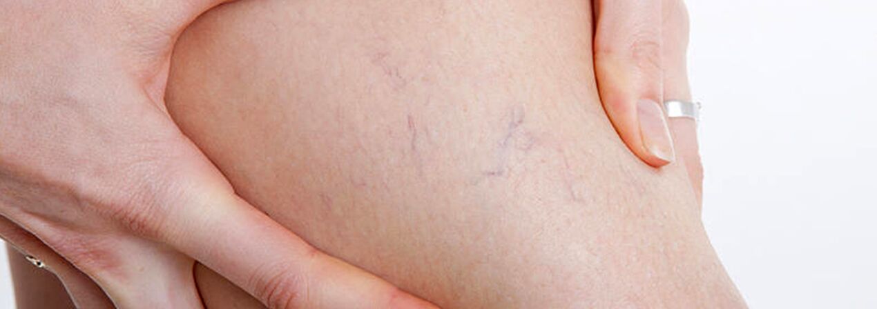 Spider veins with varicose veins