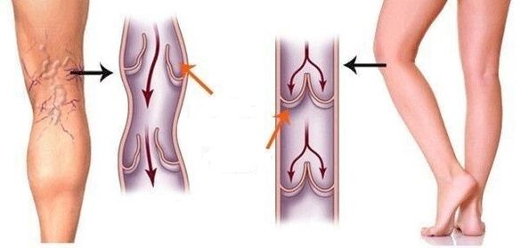 healthy veins and varicose veins